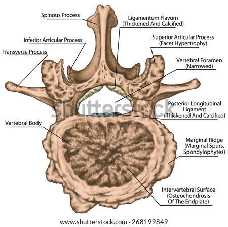 Second lumbar vertebra,  lumbar spine,vertebra, advanced uncovertebral arthrosis of the second lumbar vertebra, degenerative changes vertebra, osteophytes, spondylophytes, osteoarthritis of the joints