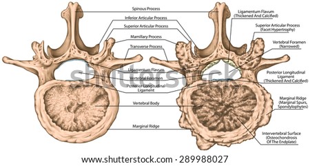 Second lumbar vertebra,  lumbar spine, vertebral bone, advanced uncovertebral arthrosis, degenerative changes vertebra, osteophytes, spondylophytes, osteoarthritis of the joints, superior view