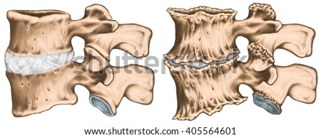 Spondylophytes involving a spinal motion segment, advanced uncovertebral arthrosis, third and fourth lumbar vertebrae, degenerative changes vertebra, lumbar vertebra,  vertebral bone, lateral view