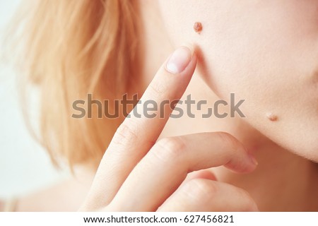 The mole on the girl\'s face closeup