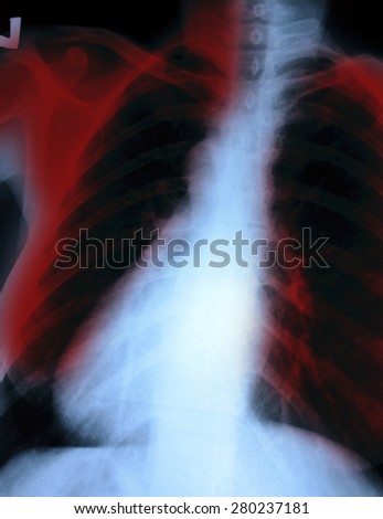 X-Ray Image Of women Chest for a medical diagnosis