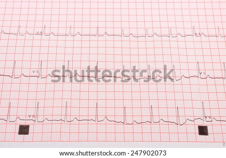 Electrocardiogram ekg heart rhythm on pink grid