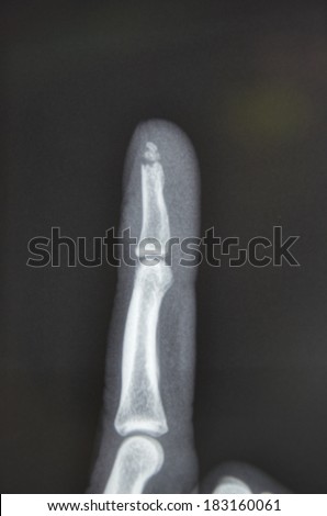 X-ray showing broken finger