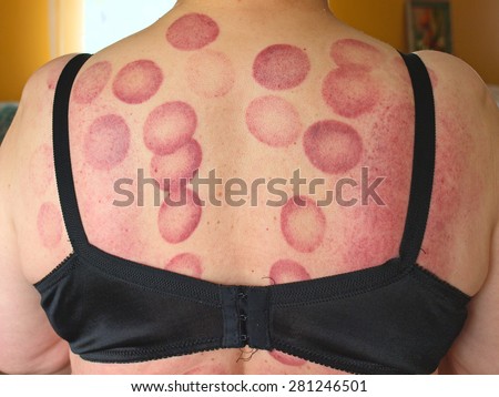 Dark red circle spots on woman`s back skin after medical cupping massage.