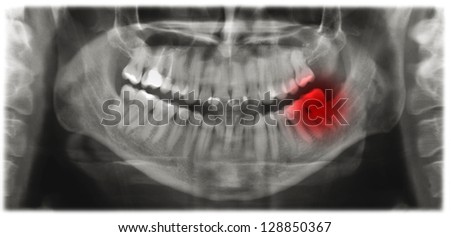 X-ray scan of the mandibular teeth. Panoramic negative image of the face of a young adult male.