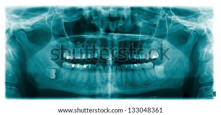 X-ray scan of the mandibular teeth. Panoramic negative image of the face of a young adult woman.