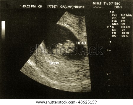 Ultrasound image of a fetus at 8 weeks