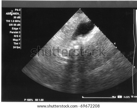 gallstones on ultrasound. stock photo : Ultrasound of