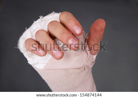 Bandaged broken hand