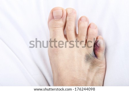 Foot with broken toe on sheet