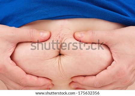 Stomach of the adult obese woman with cellulitis close-up