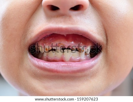 young man with a teeth broken and rotten