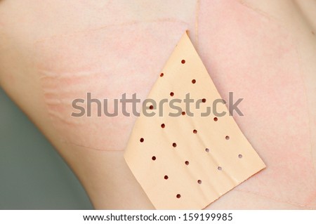 using chinese rheumatism plaster on the skin