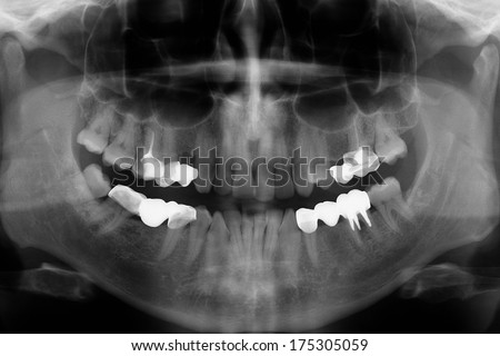 orthopantogramma x ray picture of the bottom and top jaw