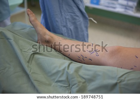Operation of varicose veins in operating room