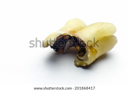 tooth decay/ badly decayed extracted teeth