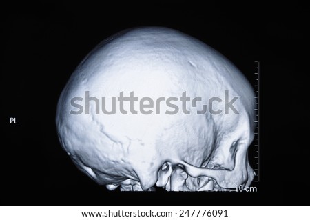 Human skull CT scans