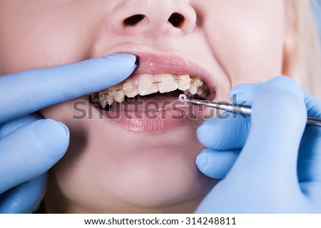 Closeup Ceramic and Metal Braces on Teeth