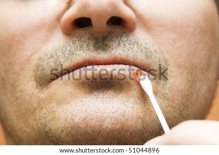 Man with  cold sore on his lips