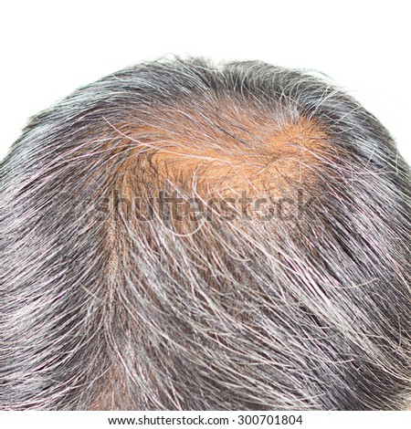 hair loss and grey hair.