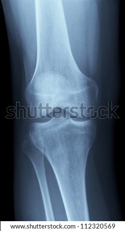 Detailed X-ray of a healthy human right knee. Image created using modern digital radiography