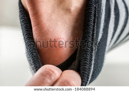 Man with a fluid blister on his heel from the rubbing and friction caused by ill fitting shoes pulling down his sock to display it to the camera.