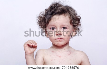 Portrait of a cute sick baby boy upset. Adorable upset child with spots on his face and body.
