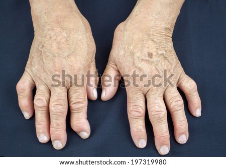 Hand Of Woman Deformed From Rheumatoid Arthritis
