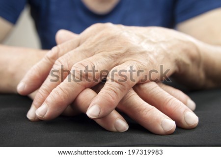 Hand Of Woman Deformed From Rheumatoid Arthritis