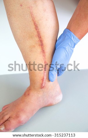 Human leg with postoperative scar of cardiac surgery. Medical concept. Heart disease