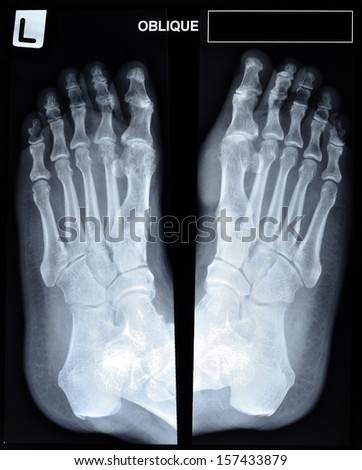 an x-ray of mature man\'s feet.