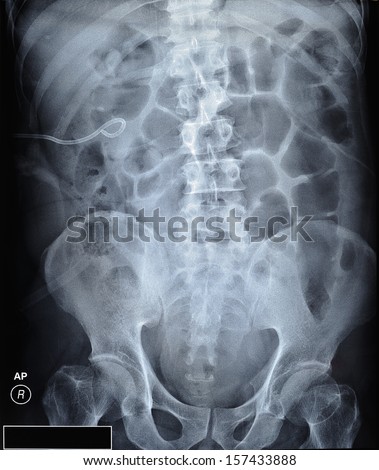 X ray film of kidney stones with ureteric stent of a 55 years old man