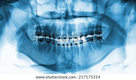 X-Ray scan human for teeth