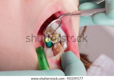 Close up of mouth and tools,  filling of tooth