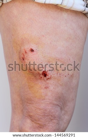 Dog bite, puncture wound on human leg