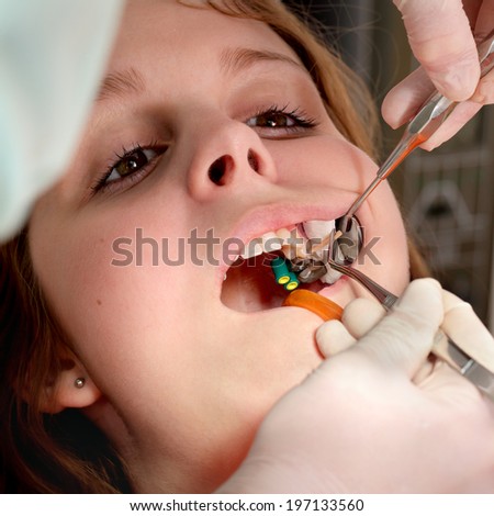 Close up of mouth and tools,  filling of tooth cavity, real people