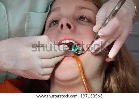 Close up of mouth and tools,  filling of tooth cavity, real people
