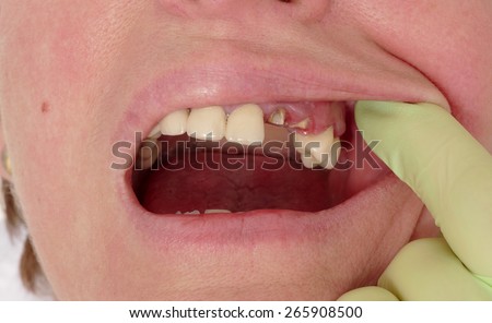 Closeup of broken artificial tooth and inflammation, gingivitis
