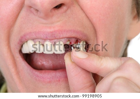Patient hold broken artificial tooth beside open  mouth