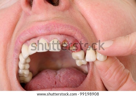 Patient hold broken artificial tooth beside open  mouth