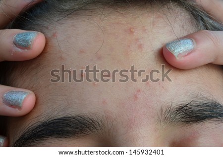 Macro shot of young girl\'s forehead with typical problem with acne and pimples at puberty