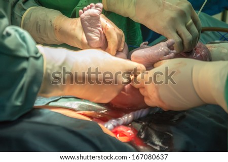 Operation for cesarean section with new born infant in operating theater.