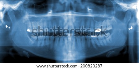 Full mouth scan of human dentil
