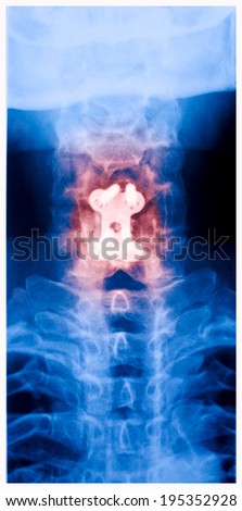 Cervical spine surgery x-ray