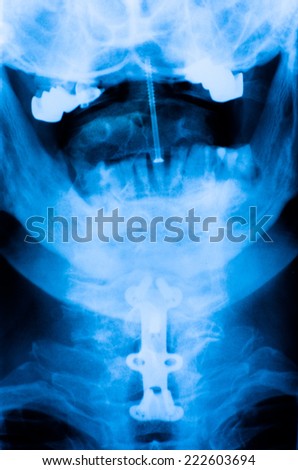 odontoid fracutre - cervical spine x-ray