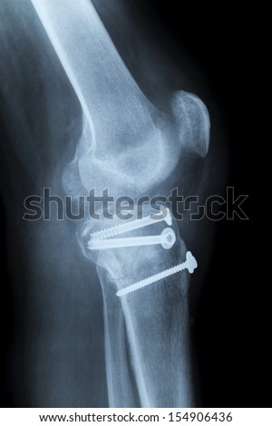 Right human knee post-operatively