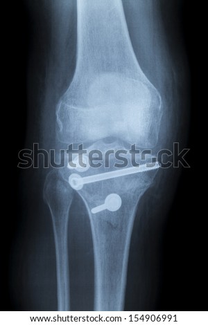 fractured knee, x-ray image after repositioning