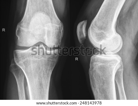 Right knee X-Ray