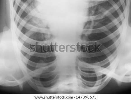 X-ray. X-ray photograph of human chest
