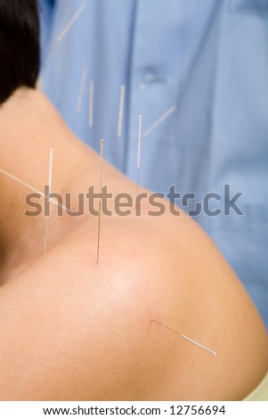 Acupuncture, alternative medicine, needles on back of a woman